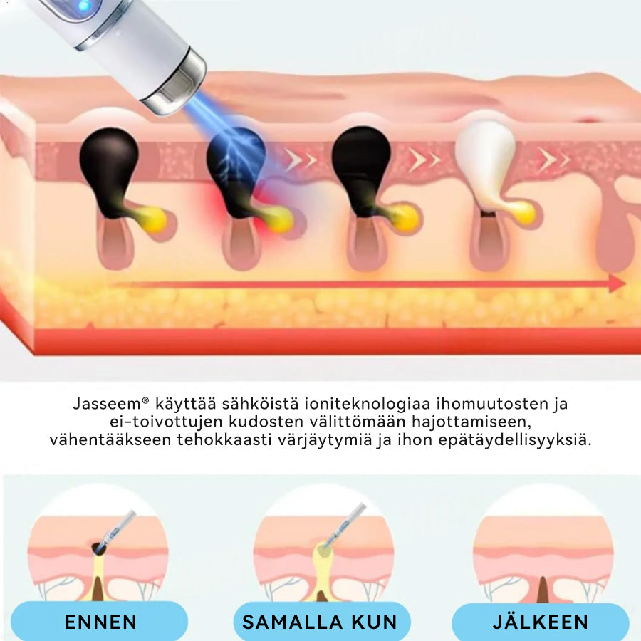 𝐉𝐚𝐬𝐬𝐞𝐞𝐦® lääkinnällisen tason laserpeni 🏆 (käyttää hiilidioksidilasertekniikkaa – poistaa tehokkaasti luomet, syylät, ihotagit, pigmenttiläiskät ja muut ihon virheet)