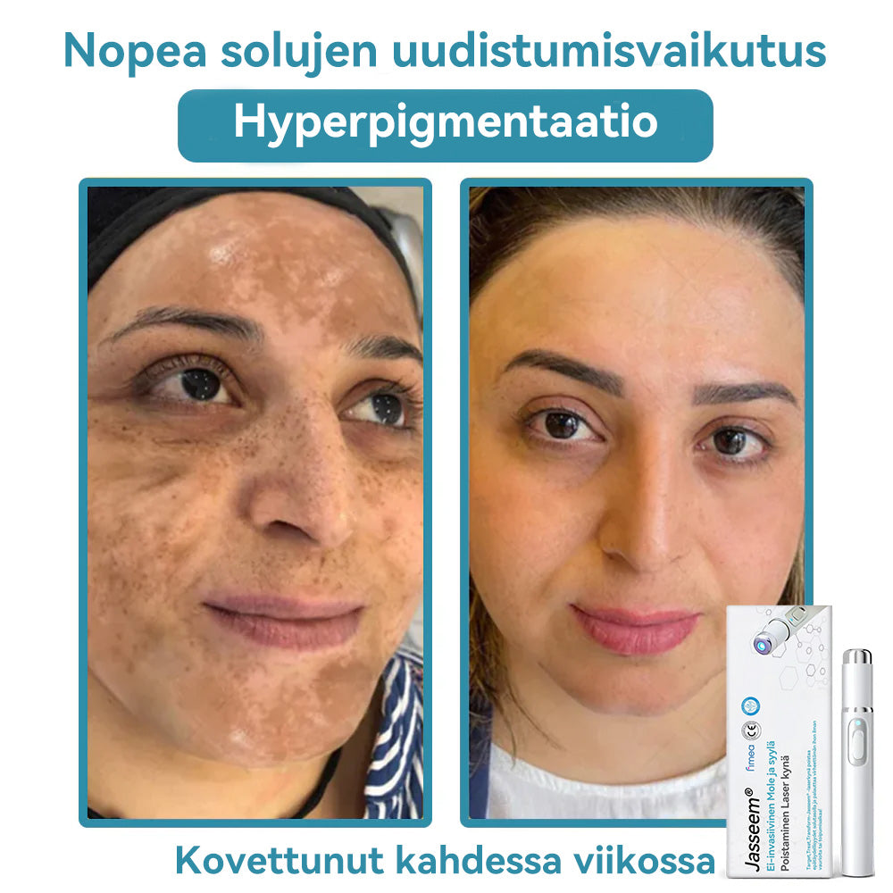 𝐉𝐚𝐬𝐬𝐞𝐞𝐦® lääkinnällisen tason laserpeni 🏆 (käyttää hiilidioksidilasertekniikkaa – poistaa tehokkaasti luomet, syylät, ihotagit, pigmenttiläiskät ja muut ihon virheet)