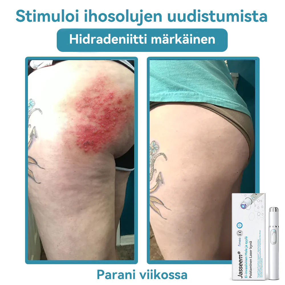 𝐉𝐚𝐬𝐬𝐞𝐞𝐦® lääkinnällisen tason laserpeni 🏆 (käyttää hiilidioksidilasertekniikkaa – poistaa tehokkaasti luomet, syylät, ihotagit, pigmenttiläiskät ja muut ihon virheet)