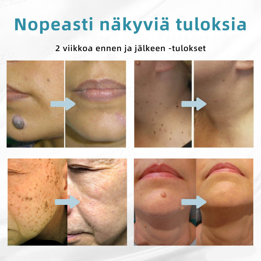 𝐉𝐚𝐬𝐬𝐞𝐞𝐦® lääkinnällisen tason laserpeni 🏆 (käyttää hiilidioksidilasertekniikkaa – poistaa tehokkaasti luomet, syylät, ihotagit, pigmenttiläiskät ja muut ihon virheet)