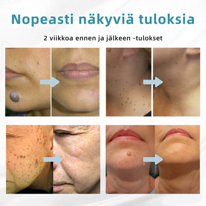 𝐉𝐚𝐬𝐬𝐞𝐞𝐦® lääkinnällisen tason laserpeni 🏆 (käyttää hiilidioksidilasertekniikkaa – poistaa tehokkaasti luomet, syylät, ihotagit, pigmenttiläiskät ja muut ihon virheet)