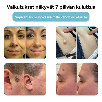 𝐉𝐚𝐬𝐬𝐞𝐞𝐦® lääkinnällisen tason laserpeni 🏆 (käyttää hiilidioksidilasertekniikkaa – poistaa tehokkaasti luomet, syylät, ihotagit, pigmenttiläiskät ja muut ihon virheet)