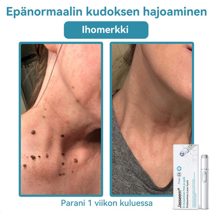 𝐉𝐚𝐬𝐬𝐞𝐞𝐦® lääkinnällisen tason laserpeni 🏆 (käyttää hiilidioksidilasertekniikkaa – poistaa tehokkaasti luomet, syylät, ihotagit, pigmenttiläiskät ja muut ihon virheet)