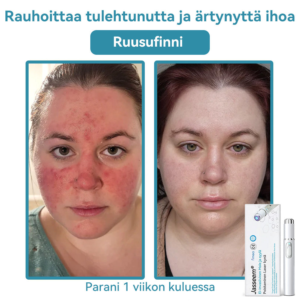 𝐉𝐚𝐬𝐬𝐞𝐞𝐦® lääkinnällisen tason laserpeni 🏆 (käyttää hiilidioksidilasertekniikkaa – poistaa tehokkaasti luomet, syylät, ihotagit, pigmenttiläiskät ja muut ihon virheet)